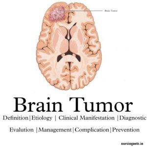 Read more about the article Brain Tumor – 2nd Year GNM Medical Surgical Nursing II, Oncology Nursing(Definition, Types, Etiology, Sign & Symptoms, Diagnosis,Treatment & Complication)