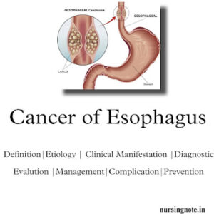 Read more about the article Cancer of Esophagus – 2nd Year GNM Medical Surgical Nursing II, Oncology Nursing(Definition,Etiology,Sign & Symptoms,Diagnosis,Treatment & Prevention)