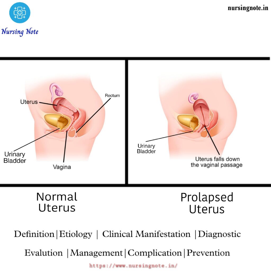 Difference between normal uterus and prolapsed uterus to understand what is Uterine prolapse