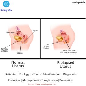 Read more about the article Uterine Prolapse – 3rd Year GNM, Midwifery and Gynecological Nursing (Definition, Causes, Stages, Sign and Symptoms, Diagnosis,Treatment and Prevention)