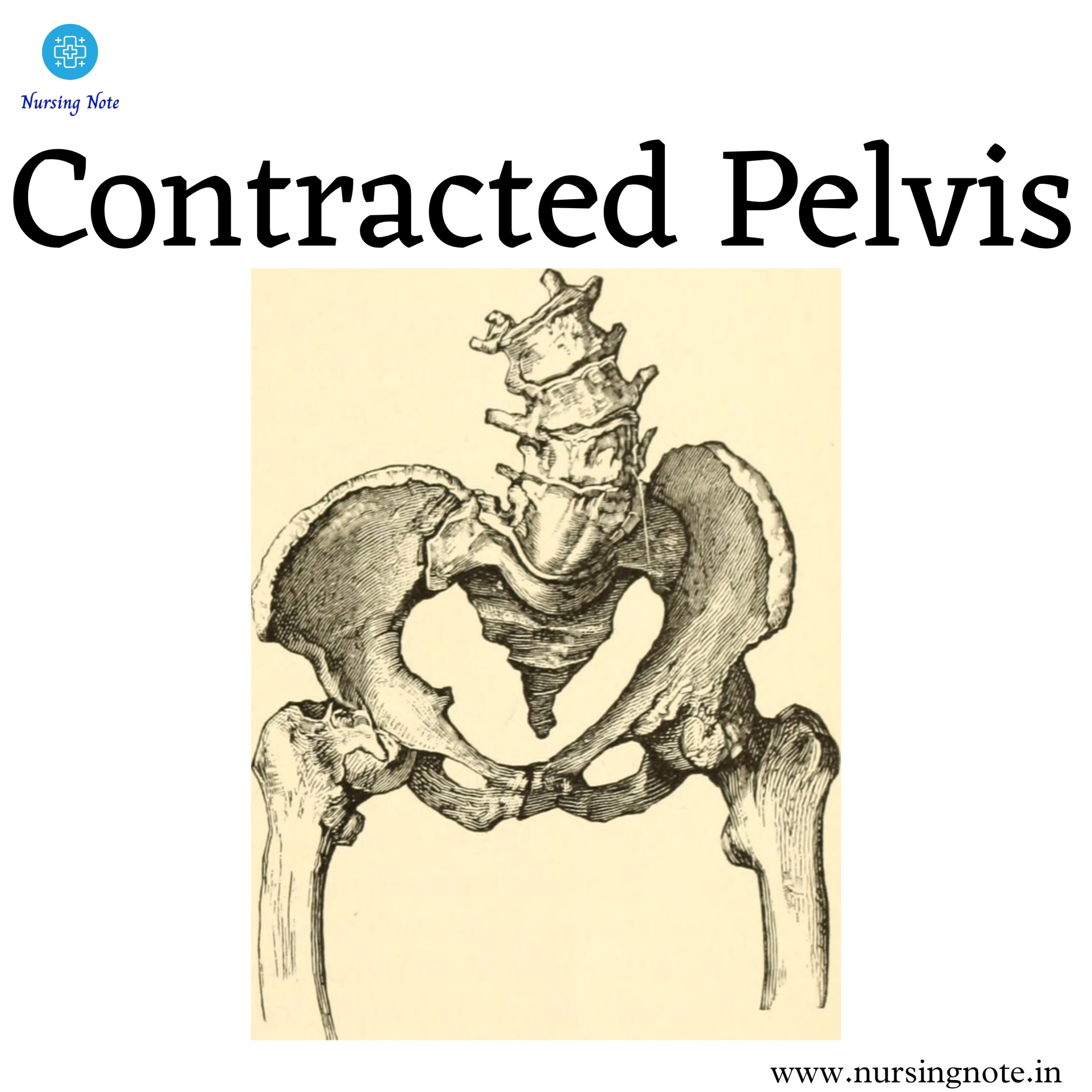 Read more about the article Contracted Pelvis: Definition, Causes, Signs, Diagnosis, Complication and Treatment