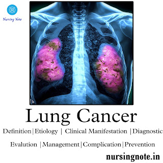 Read more about the article Lung Cancer – 2nd Year GNM Medical Surgical Nursing II, Oncology Nursing(Definition,Etiology,Sign & Symptoms,Diagnosis,Treatment & Prevention)