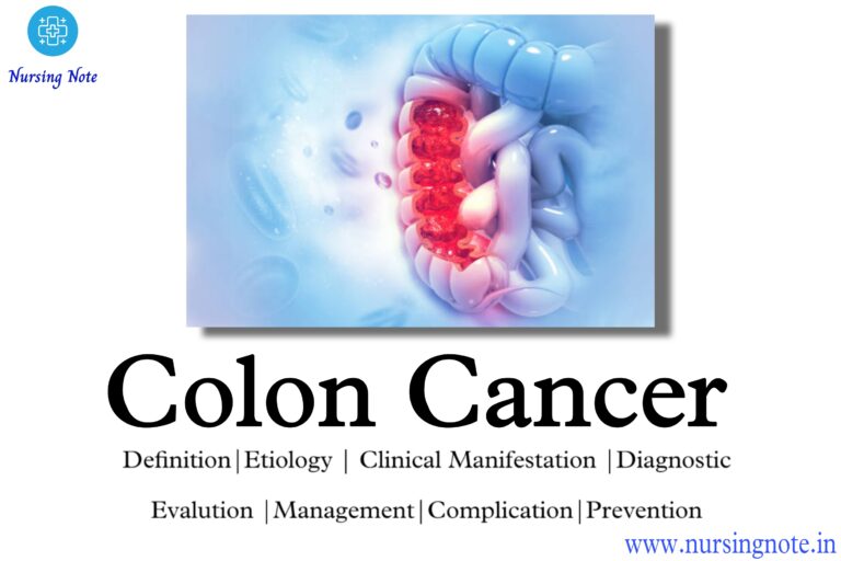 Educational graphic on colon cancer
