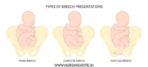 Read more about the article Breech Presentation: Definition,Type, Etiology and Mechanism for 3rd Year GNM A Complete Note