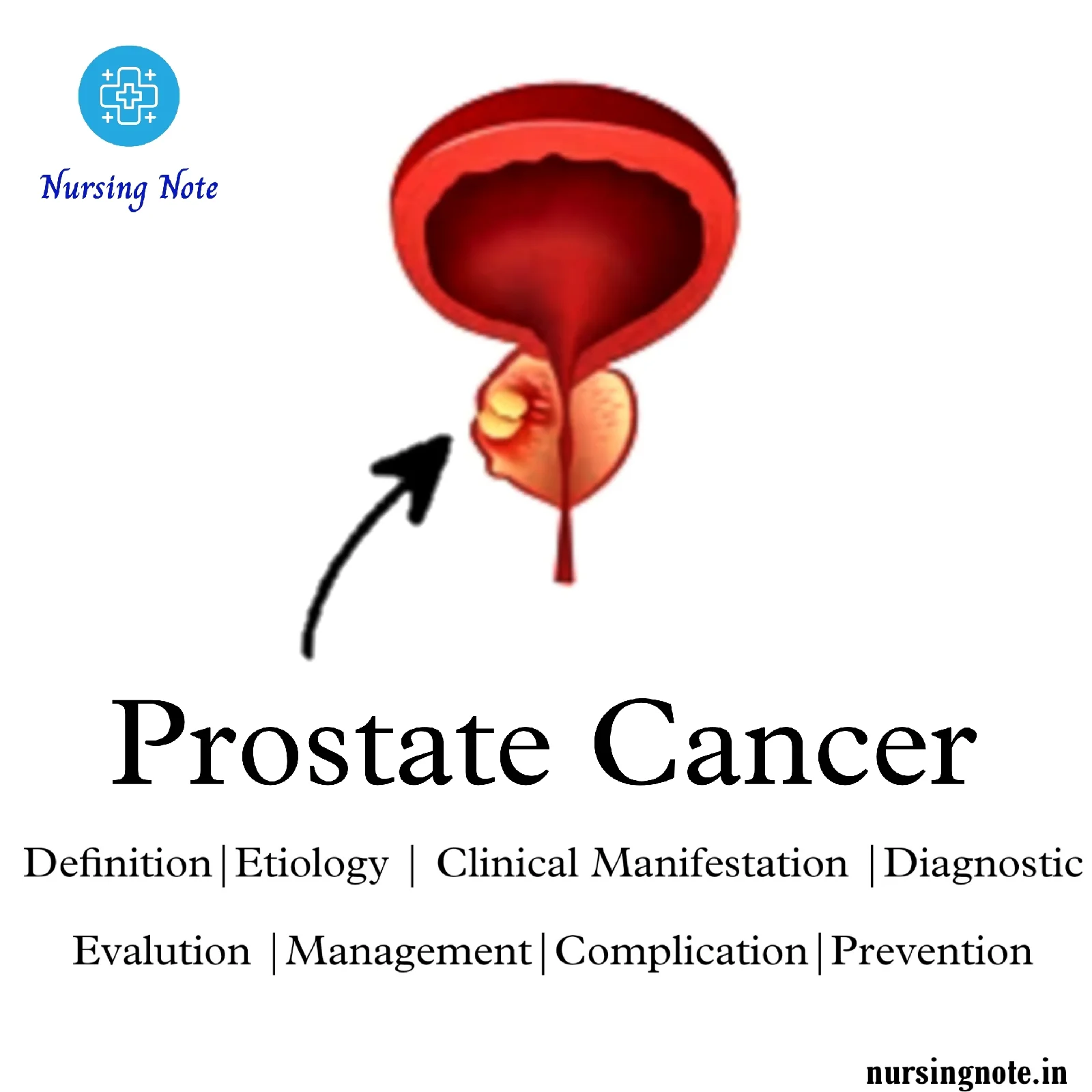 Illustration of prostate cancer