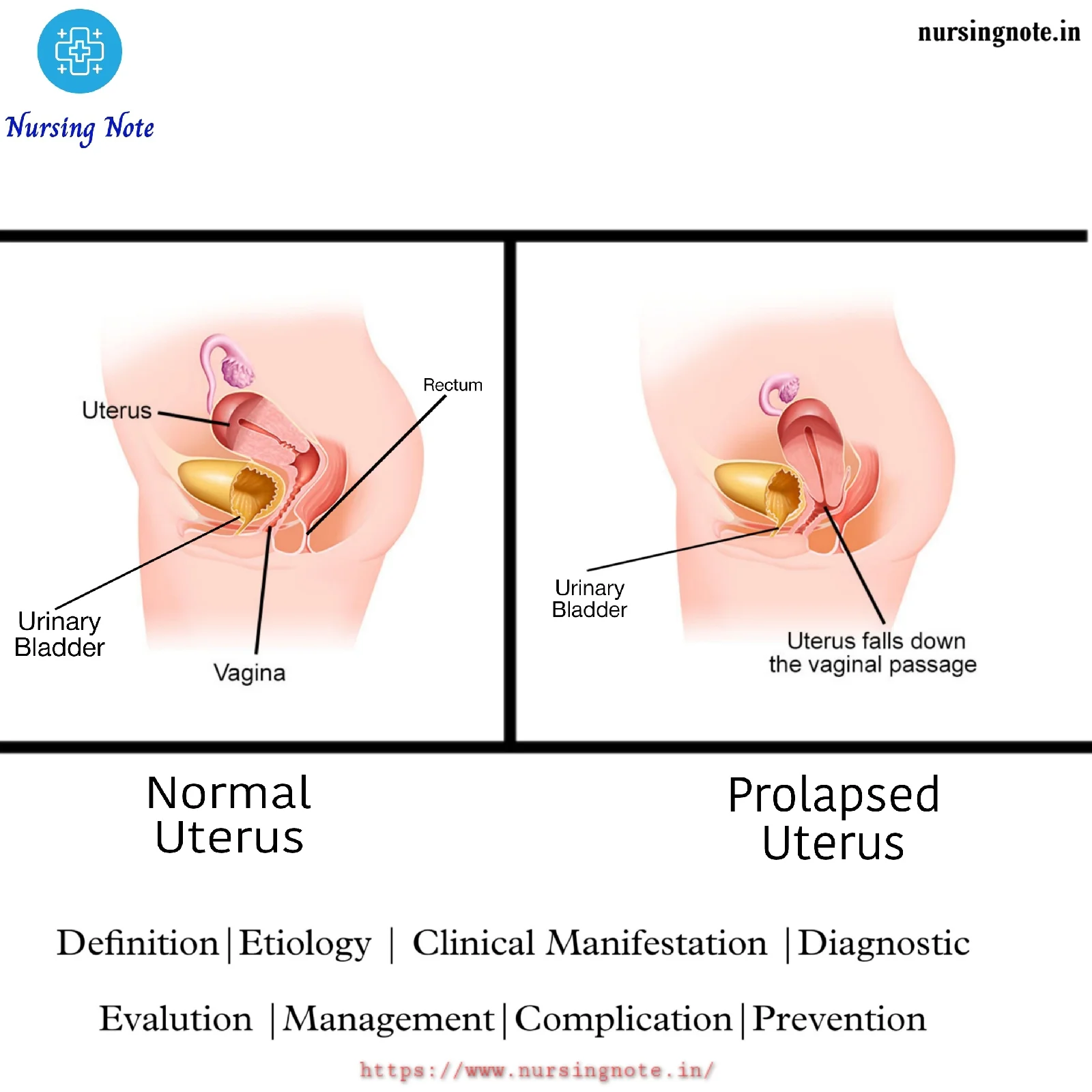 Difference between normal uterus and prolapsed uterus