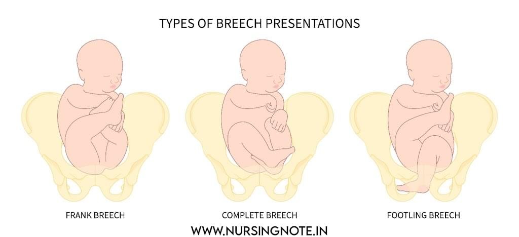 Breech Presentation: Definition,Type, Etiology and Mechanism for 3rd ...